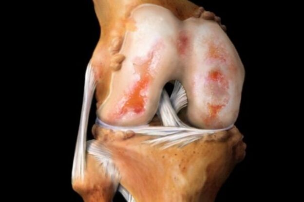 Destruction de l'articulation du genou due à l'arthrose - une pathologie courante du système musculo-squelettique