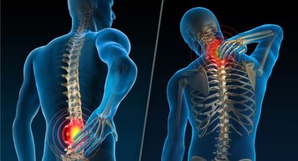 Signes indiquant le développement de l'ostéochondrose - douleurs au cou et au bas du dos