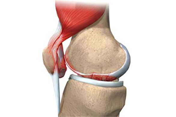 Complications de l'arthrose