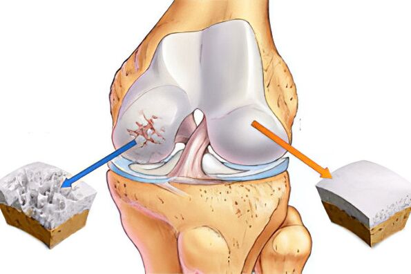 Qu'est-ce que l'arthrose