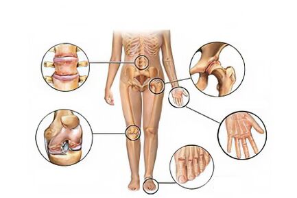 Types d'arthrose