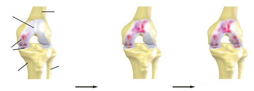 Étapes de l'arthrose