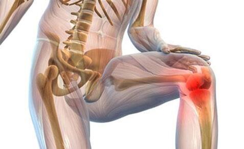 Arthrose de l'articulation du genou