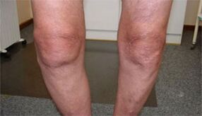 symptômes de l'arthrose