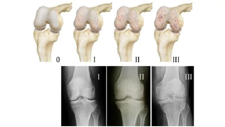 Stades de l'arthrose de l'articulation du genou sur les radiographies