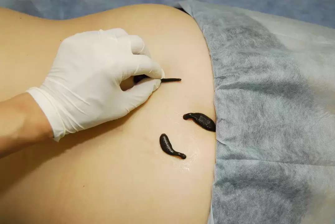 placement de sangsues pour l'ostéochondrose lombaire
