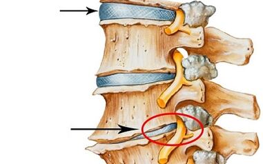 stades de développement de l'ostéochondrose cervicale