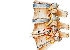 causes de l'ostéochondrose cervicale