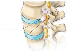 principaux symptômes de l'ostéochondrose cervicale