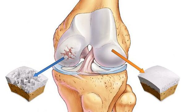 Modifications articulaires de l'arthrose (à gauche) et du cartilage normal (à droite)