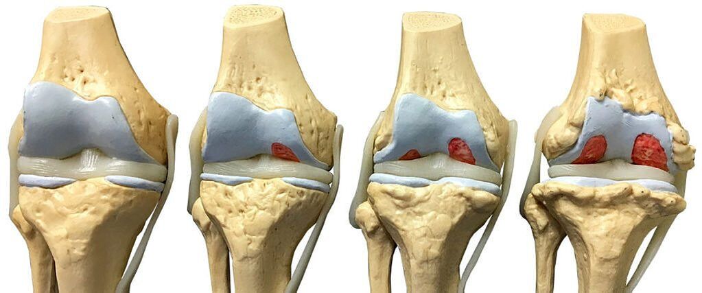 Degrés d'arthrose de l'articulation du genou
