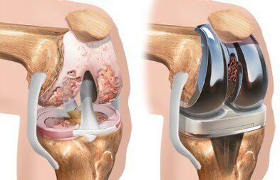 Endoprothèse de l'articulation du genou avec gonarthrose